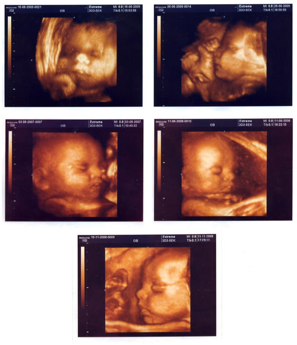 Пренатальный УЗИ - СКРИНИНГ 3-го триместра: 30 (30-34) недель беременности